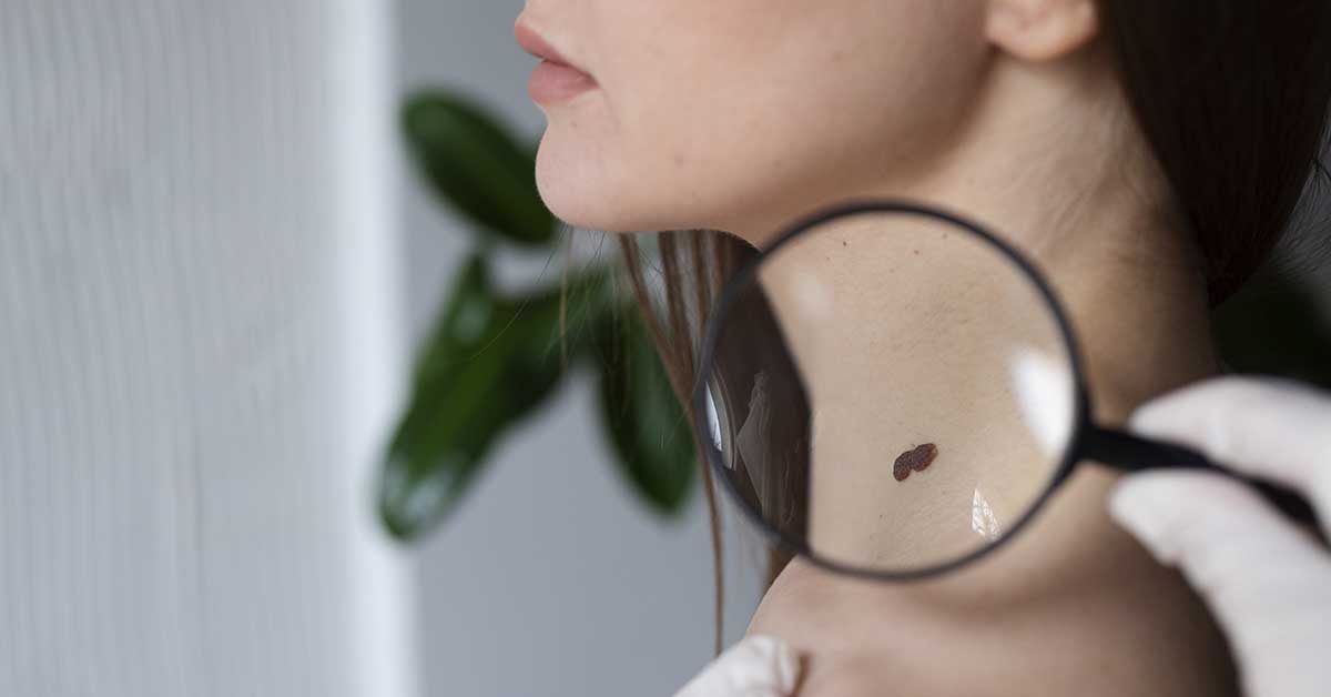 Terapias inovadoras para câncer de pele da cabeça e pescoço: o que você precisa saber