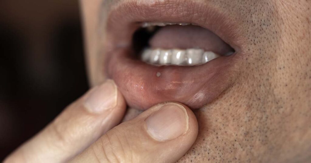 Câncer de boca: importância do acompanhamento contínuo e prevenção de recidivas